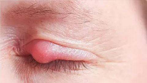 Are Styes Contagious