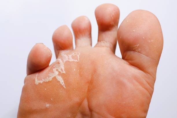 Foot Fungus