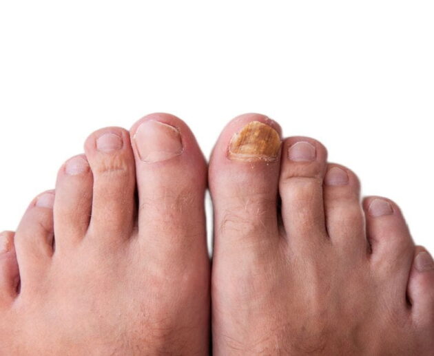 Foot Fungus