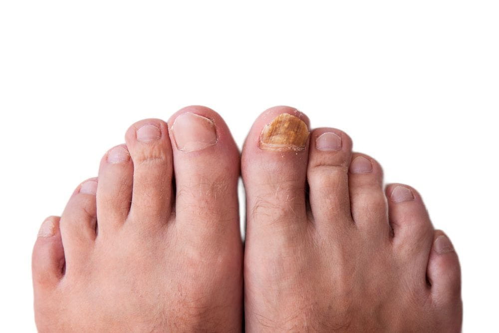Foot Fungus