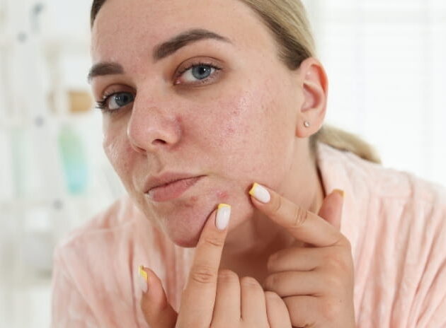 Pimples Dermatologist Care