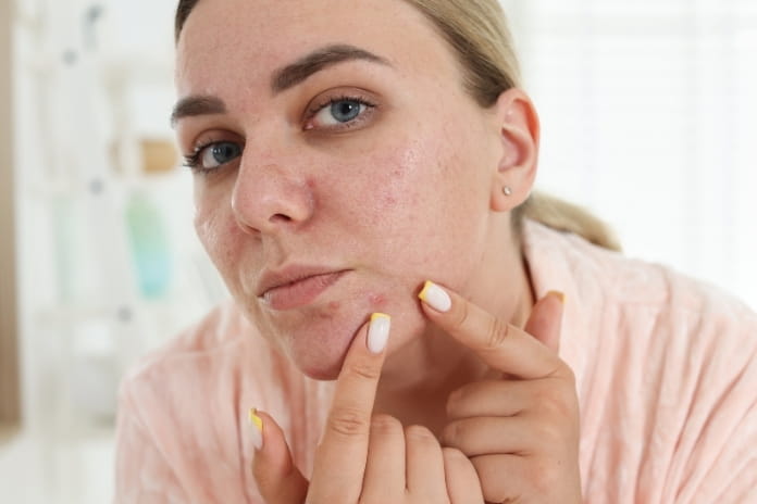 Pimples Dermatologist Care