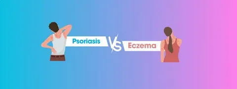 psoriasis vs eczema