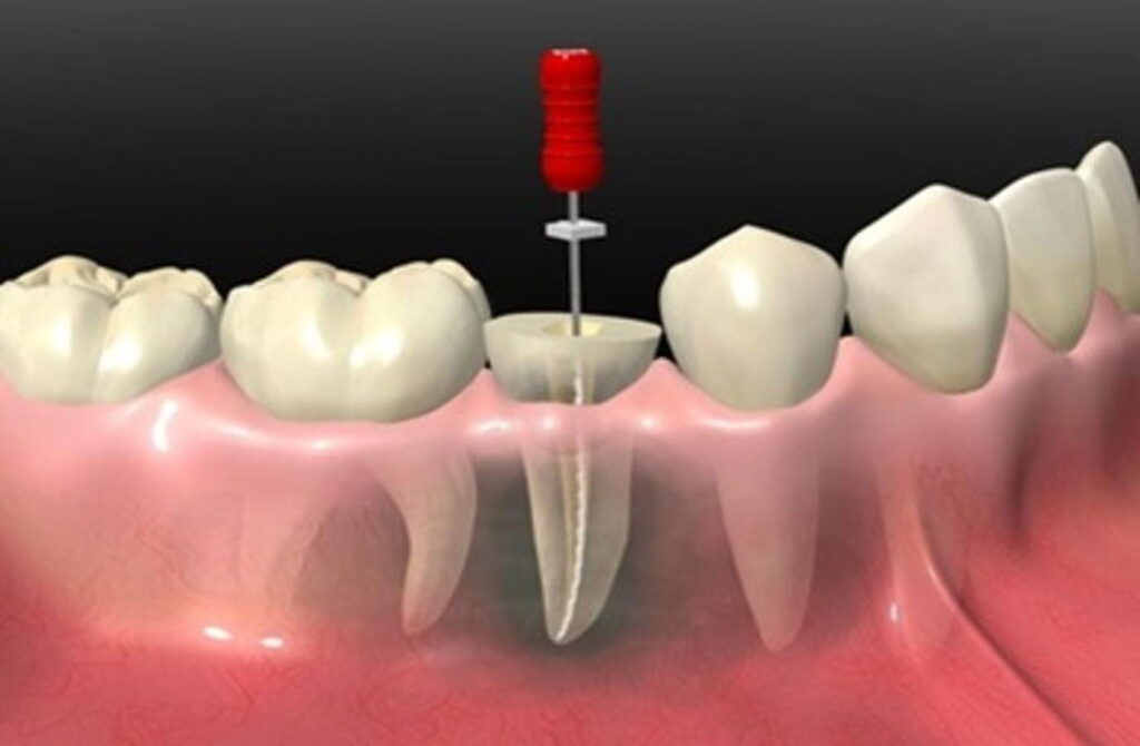 rcts dental